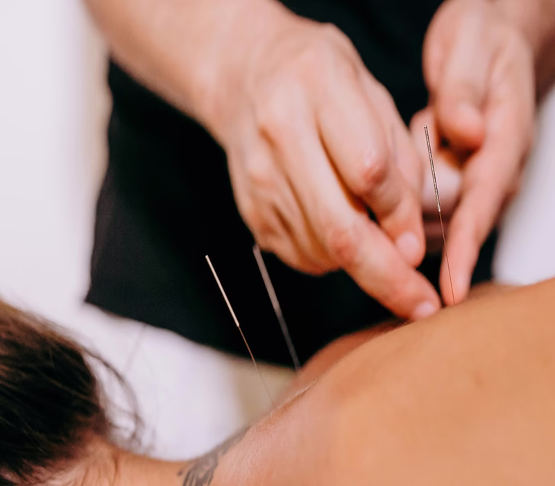 service image - acupunture